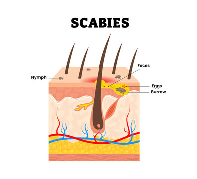 Scabies mite skin structure. Labeled nymph, feces, eggs, burrow. Contagious skin infestation by the mite Sarcoptes scabiei. Human skin layers anatomy cross section. Vector illustration