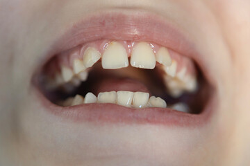 Close-up view of a child's mouth showing baby teeth and gaps, highlighting dental development and growth stages