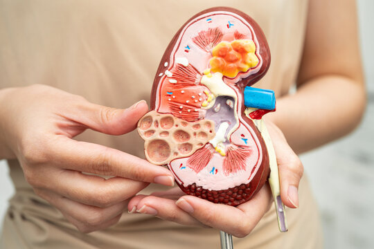 Chronic kidney disease, Asian woman with model for treatment urinary system, urology, Estimated glomerular filtration rate eGFR.