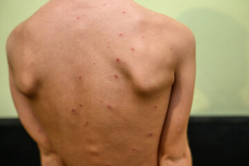 Boy with chickenpox. Rash on child body 