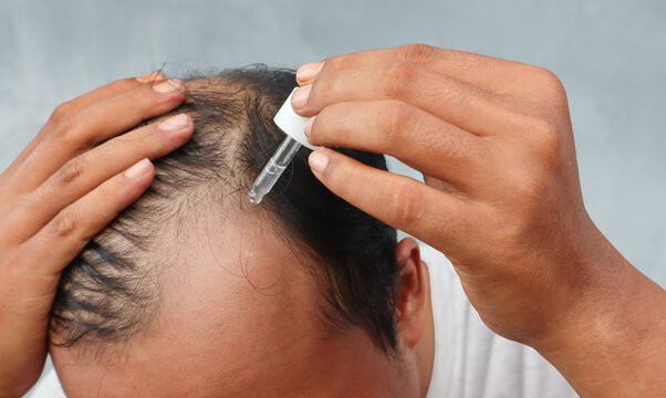 An Asian man is dripping with pipette a hair nourishing serum on a thinning head area. Focus on the head