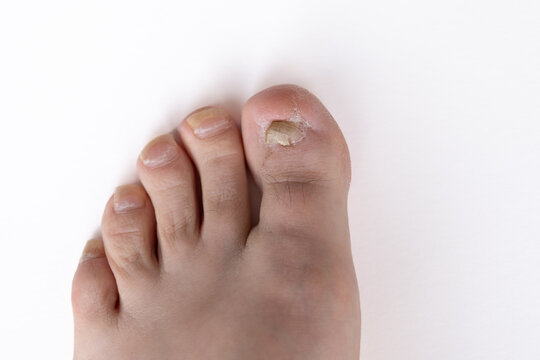Big toe after treatment for an ingrown toenail. The nail bed is clean and healing, with new nail growth visible. Suitable for medical education, podiatry training, or healthcare articles.