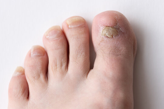 Detailed view of a patient&rsquo;s toe recovering after ingrown toenail removal. The nail shows signs of regrowth despite chemical burn treatment, ideal for podiatry, wound management, clinical education
