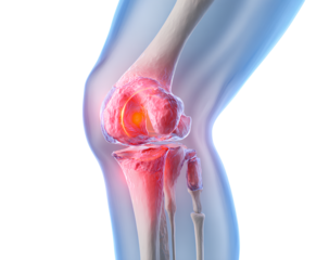 Knee joint pain illustration showcasing anatomy of discomfort caused by inflammation affecting mobility in health concept