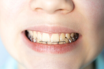 Young person showing teeth with dental braces in a close-up view during an orthodontic treatment session
