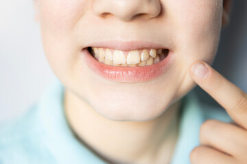 Smiling child showing teeth with a pointer finger in a bright indoor setting during daylight hours