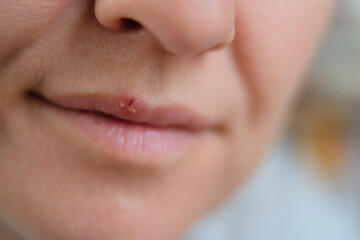 Macro view of female lips with herpes blister during cold or flu. Symbol of illness, self care, hygiene, and health protection.