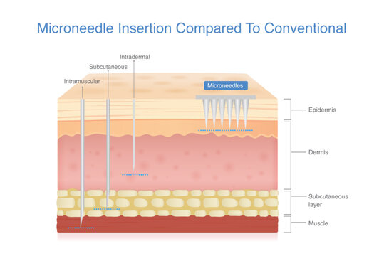 Microneedle insertion human skin layers compared to conventional with intramuscular, subcutaneous, and intradermal injection methods.
Illustration about skin maintenance with medical derma technology.