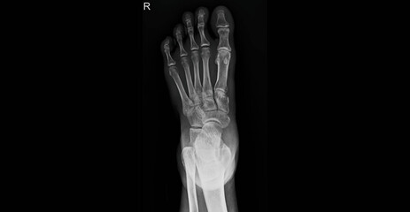 Foot x-ray radiograph showing bones, toes, metatarsals and ankle joint. Dorsal view plain film for diagnostic examination of foot skeletal structure and bone anatomy