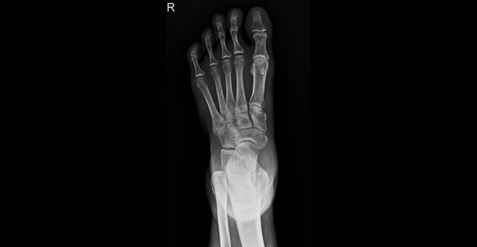 Foot x-ray radiograph showing bones, toes, metatarsals and ankle joint. Dorsal view plain film for diagnostic examination of foot skeletal structure and bone anatomy