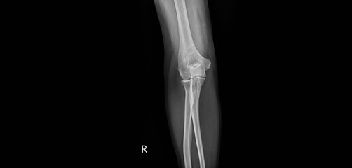 Elbow x-ray radiograph showing humerus, radius, ulna and joint. Lateral view plain film for diagnostic examination of elbow bone structure and articulation anatomy