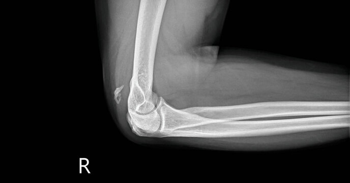 Forearm x-ray radiograph showing radius, ulna and elbow joint. Lateral view plain film for diagnostic examination of forearm bone structure and skeletal anatomy