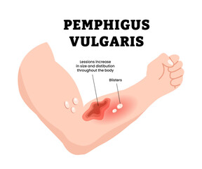 Pemphigus vulgaris disease signs and symptom with arm or hand. Rare autoimmune disorder causing blisters. Lesion increase. Skin problem condition. Dermatology concept. Vector illustration