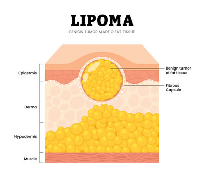  Lipoma skin structure anatomy cross section. Benign tumor of fat tissue and fibrous capsule. Adipose tumor or Fatty lump. Medical poster diagram vector illustration.