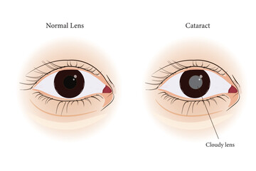 Medical illustration comparing normal eye lens and cataract with cloudy lens. eps 10