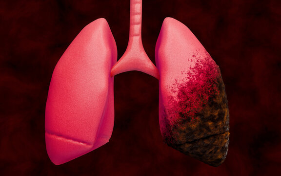 Graphic depiction of lung cancer caused by chronic smoking, illustrating diseased, tar-covered lungs, carcinogen damage, risks for smokers, raising awareness about health hazards. 3D rendering.
