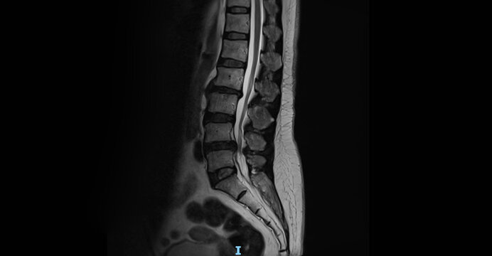 MRI of lumbar spine showing vertebrae, intervertebral discs and spinal cord. Sagittal view magnetic resonance imaging for diagnostic examination of lower back and spine anatomy