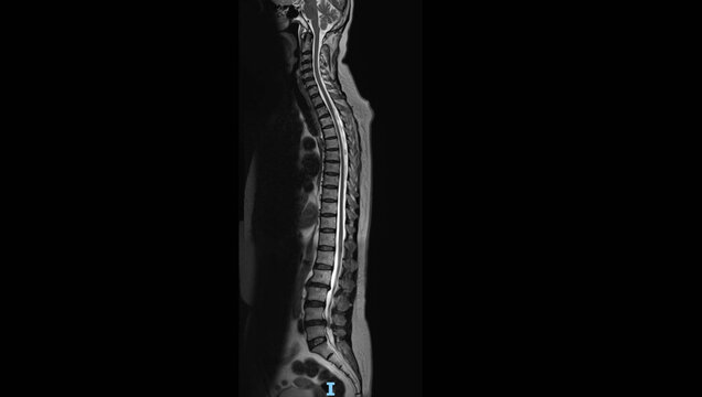 MRI of whole spine showing cervical, thoracic and lumbar vertebrae with spinal cord. Sagittal view magnetic resonance imaging for diagnostic examination of complete spine anatomy