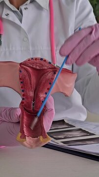A gynecologist using a model of a woman's uterus for a gynecological smear to determine and characterize the microflora of the genitourinary tract