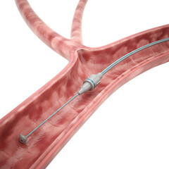 Angioplasty Catheter Inside of a Coronary Artery Blood Vessel to Remove Plaque