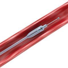 Angioplasty Catheter Inside of a Coronary Artery Blood Vessel to Remove Plaque