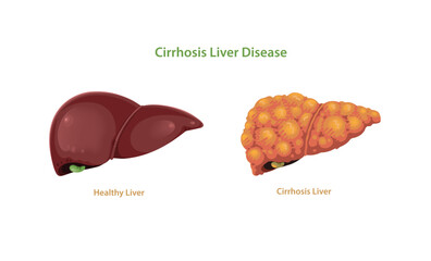 Cirrhosis Liver Disease