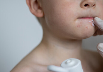 Hands with gloves putting cream on boys face with red rash infection around his mouth, blurred...