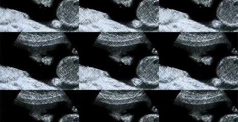 Ultrasound display screen with fetus image during obstetric examination in pregnancy monitoring