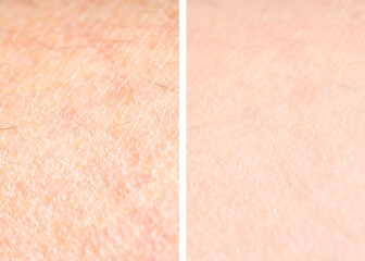 Dry skin before and after moisturizing, marco view. Collage for comparison