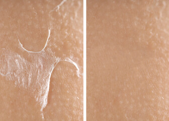 Fototapeta premium Dry skin before and after moisturizing, marco view. Collage for comparison