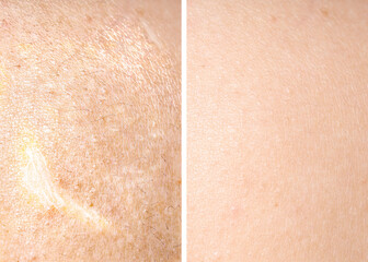 Fototapeta premium Dry skin before and after moisturizing, marco view. Collage for comparison