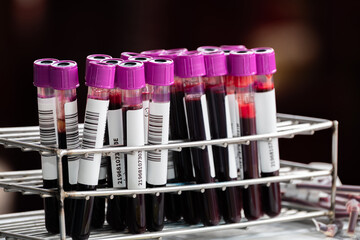 Close up of blood samples in test tubes with purple caps arranged in a metal rack at a laboratory. Medical analysis and health testing concept for diagnosis, research, and clinical examination.