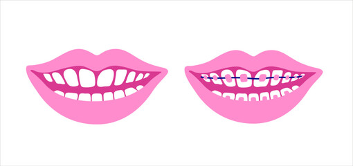 Smiling mouth with dental braces. Smiling teeth. Orthodontic Treatment Concept. Vector isolated illustration.