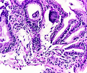 Endoscopic biopsy of oesophagus, microscopically show hyperplastic oesophageal mucosa, focal basal cell hyperplasia, papillae lamina propria. Barrett's oesophagus.