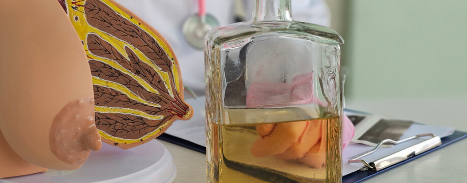 Alcohol increases risk of breast cancer, alcohol is dangerous for health, breast cancer. Doctor holds female breast anatomy concept