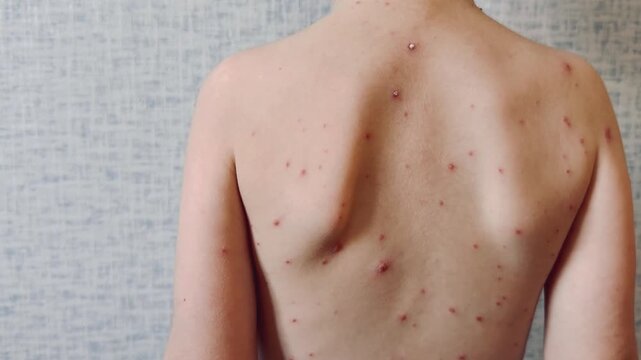 Child with chickenpox showing red rash and blisters on back caused by viral infection
