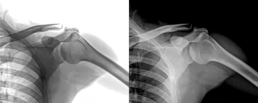 Shoulder Lateral View X-Ray Radiograph Showing Bone Structure and Diagnosis of Degenerative Diseases, Injury Prediction Isolated on Transparent Background