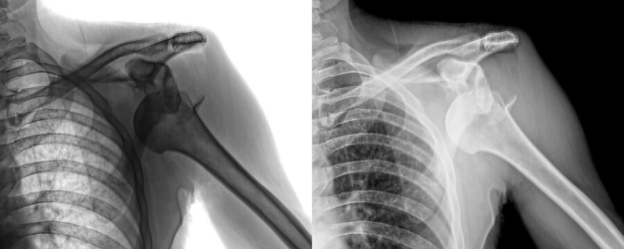 Lateral Shoulder X-Ray Radiograph Showing Glenoid Cavity and Humeral Head Alignment for Assessment of Degenerative Diseases and Isolated on Transparent Background