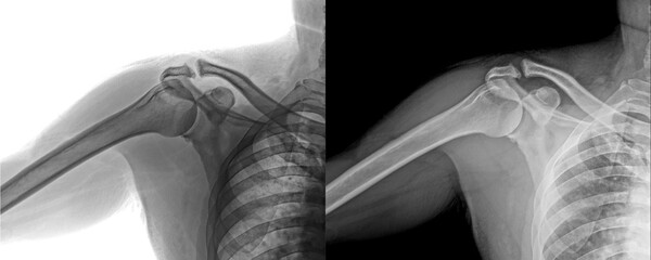 Shoulder Lateral X-Ray Radiograph Displaying Bone Structure Diagnosis of Degenerative Disorders and Injury Prognosis Isolated on Transparent Background