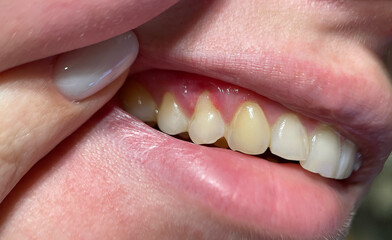 Close up of human mouth showing gum inflammation and dental issue. Concept of oral hygiene, gingivitis, dental care, tooth disease, and healthcare prevention.