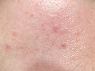 Close up of irritated human skin showing redness, bumps, and inflammation. Ideal for dermatology, skincare issues, allergy symptoms, medical illustration, and health education materials.