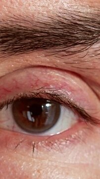 eye irritation closeup, man displaying allergy symptoms visibly, detailed view of swollen eyelid and bloodshot sclera, intimate shot highlighting skin details and signs of ocular discomfort