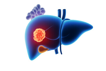 Human liver, with a tumor and gallstones, cutout, PNG isolated on white or transparent background