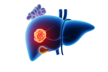 Human liver, with a tumor and gallstones, cutout, PNG isolated on white or transparent background