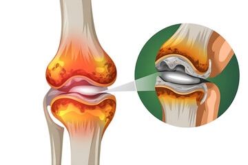 Human knee joint, showing bone structure and cartilage detail, cutout, PNG isolated on white or transparent background