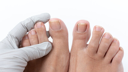 Close-up of a healthcare professional examining a patient's toenail infection, showcasing detailed...