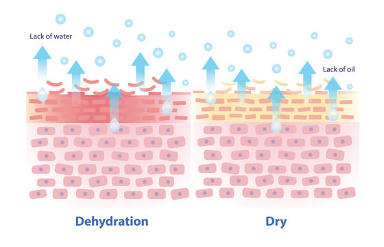 The mechanism of dehydration and dry skin vector illustration on white background. Comparison of dehydrated skin lacks water, feel dull, rough, tight and dry skin lacks oil, feel flaky, itchy. 