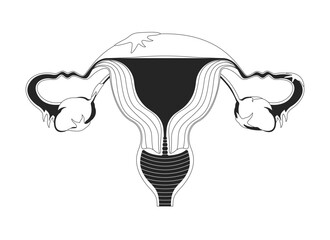 Female reproductive system with endometriosis lesions outline illustration. Ovary inflammation. Chronic illness. Fallopian damage 2D line object isolated on white. Monochrome vector ink linear image