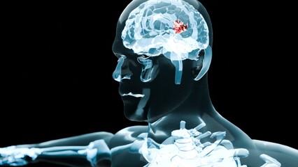 3d rendered of cancerous tumor growing inside the human brain, brain tumor and brain disease, medical exam, modern xray