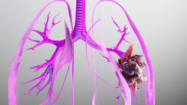 3d human lungs Cancer , cancer growth , Tumor growing, 3D Rendered Medical Animation , Lungs Cancer Visualization , Pneumonia illness ,High quality 4k footage